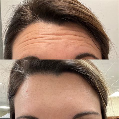 Before and After | Swisher Skin and Laser Center