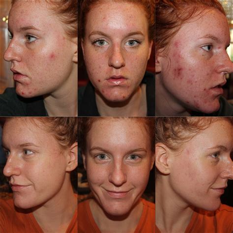 [B&A] So grateful for the skin I have now, thank you r ...