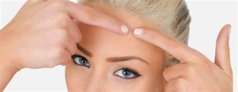 Составы для удаления угрей включают разные травы. Мы рассмотрим самые ...