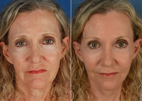 fat transfer  naples fl patient