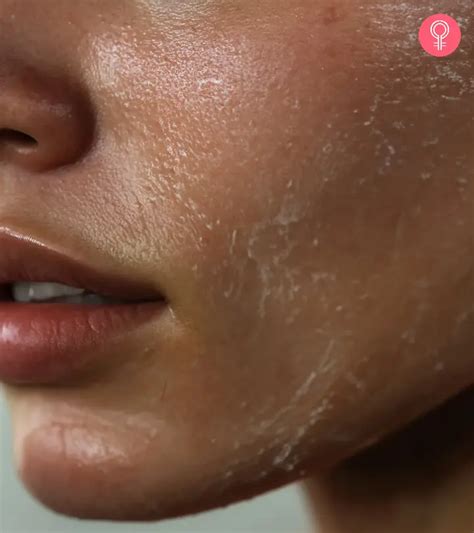 flaky skin skin peeling  reasons  skin  peeling