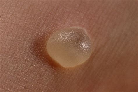 rid  blisters fast