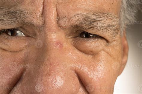 Man with a pimple on the bridge of his nose 18967151 Stock Photo at ...