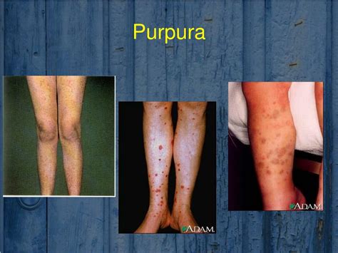 O Que É Purpura No Sangue - PPT - VASCULAR PURPURAS PowerPoint Presentation, free download - ID:2239367