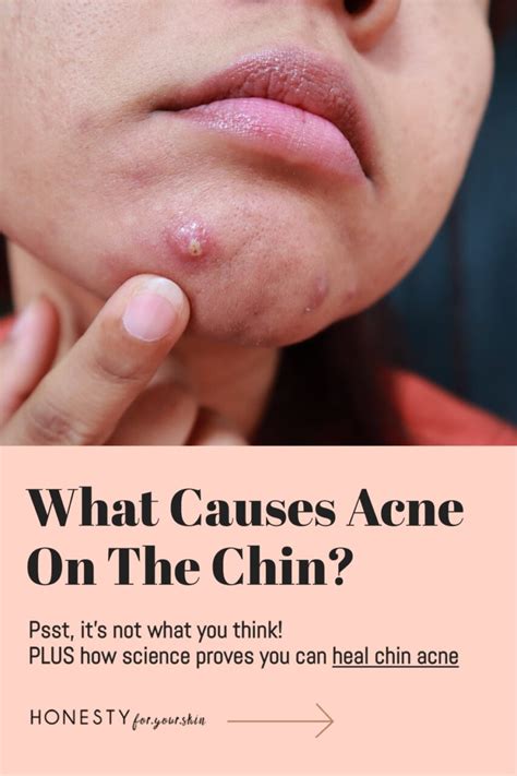 hormonal cysts  chin hormones  cystic acne