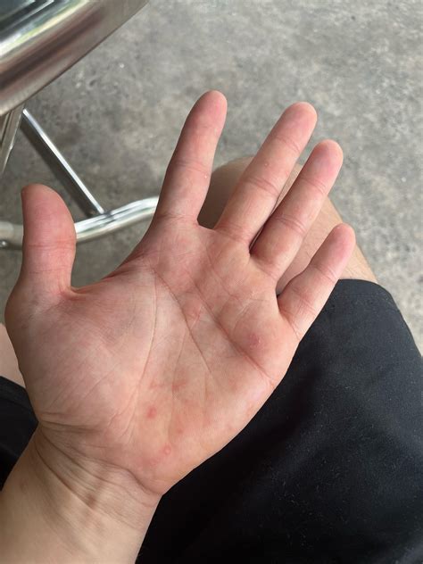[Misc] Little Bumps on Palm and around fingers. : r/SkincareAddiction