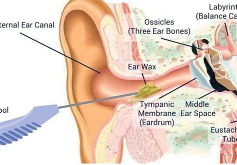 Ear Wax Removal Using Microsuction | Clear Ears Clinic