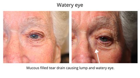 watery eyes