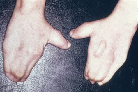 Apert Syndrome