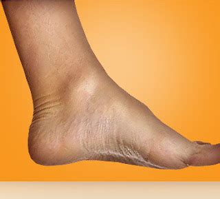 Growing Together in Health Care: Protect Those Bony Prominences!
