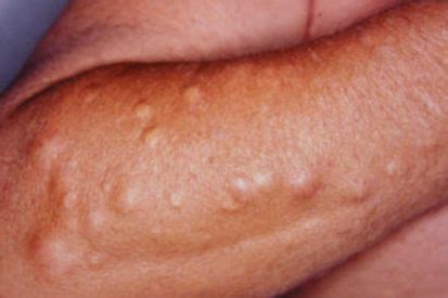 Cysts | Symptoms, Causes, Treatment | Cumberland Skin