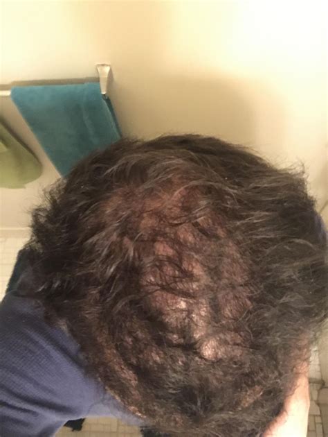 Cortisone Shot Hair at Jenny Abate blog