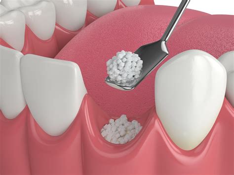 Bone Grafts in Modern Dentistry: An In-Depth Exploration
