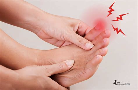 The Anti-Inflammatory Naproxen Beats Colchicine for Gout Flares