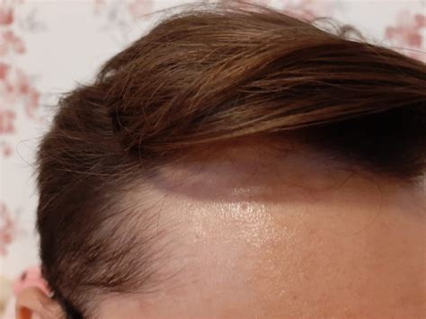 Hello guys. Is this balding or just widow's peak hairline? : r ...