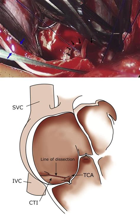 Atrial Flutter Ablation Procedure