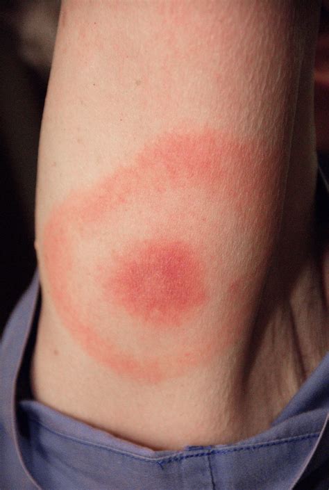 As Lyme Disease Cases Rise, Tips for Protecting Against Tick Bites