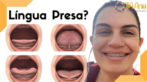 Língua Presa Como Resolver - Como Saber Se Tenho Lingua Presa - FDPLEARN