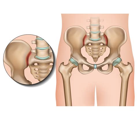 Pelvic Girdle Pain Treatment: Symptoms, Therapy & Causes| QI Spine