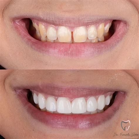 facetas em resina quanto custa pra  servem onde fazer