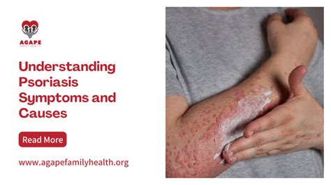 Understanding Psoriasis Symptoms and Causes - Agape Family Health