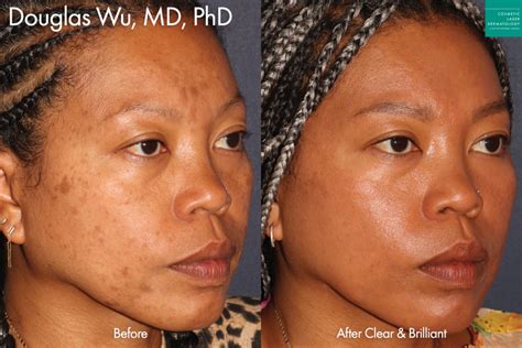 fractional resurfacing  hyperpigmentation  solution  uneven