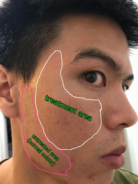 PIH from acne scar treatment – Hyperpigmentation – red/dark marks ...