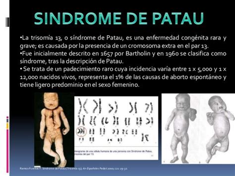 Sindrome de patau