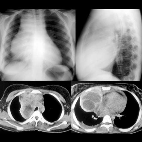 Pediatric Hodgkin Lymphoma | Pediatric Radiology Reference Article | Pediatric Imaging ...