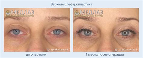 Блефаропластика до и после: фото результатов в клинике МедЛаз