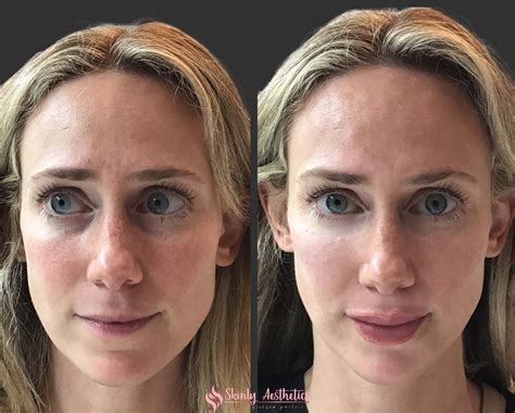 Lip Filler Before & After Results - Skinly Aesthetics