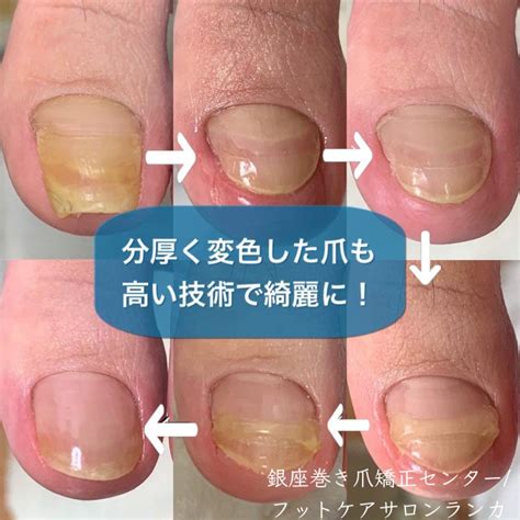 foot care runka
