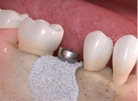 Dental Bone Graft Source at Cynthia Heather blog