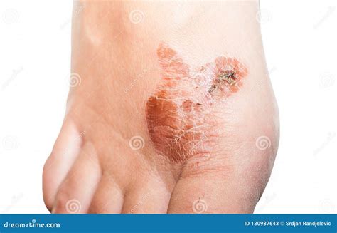 Extreme Bad Foot Skin Bacterial Fungal Infection with Damage Close Up Partially Isolated on ...