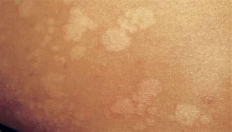 jamur  badan manusia perumperindocoid