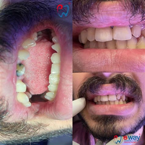 Experience the Ultimate Dental Lab Gallery | Eway Dental Lab