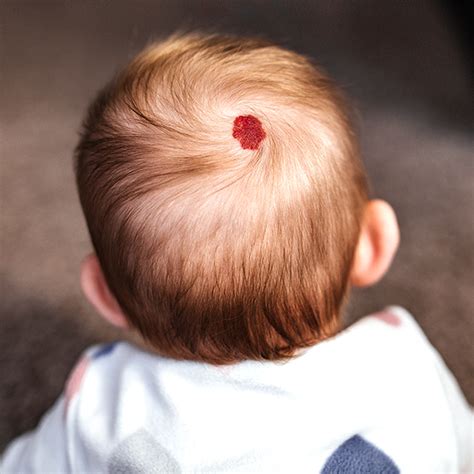 cool shaped birthmarks