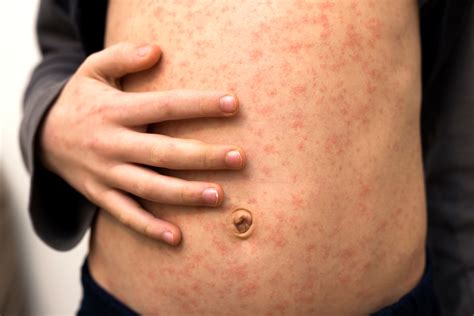 Symptoms Of Rubella In Kids