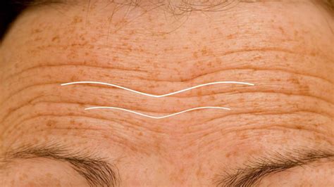 forehead lines award winning aesthetics medical clinic