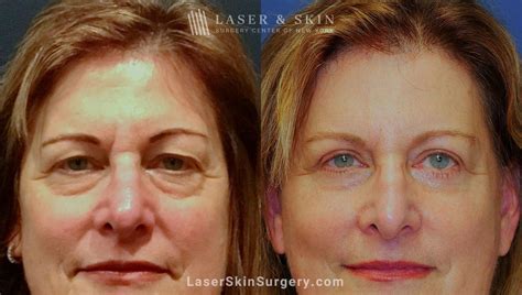 eye bags treatment  troy haynes blog