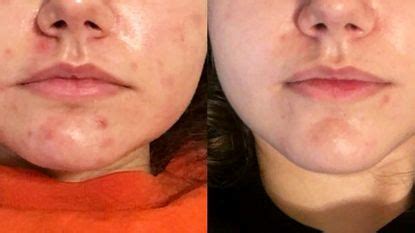 How Rosehip Oil Got Rid of This Woman's Acne in Only 3 Weeks | Marie Claire