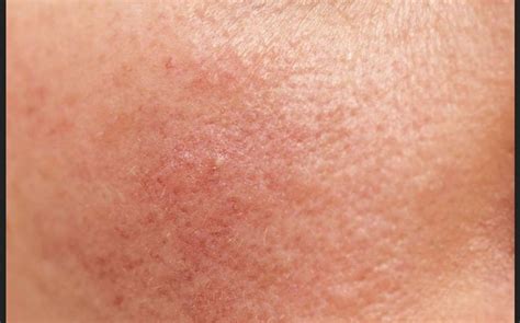 mengatasi kulit kering  kasar