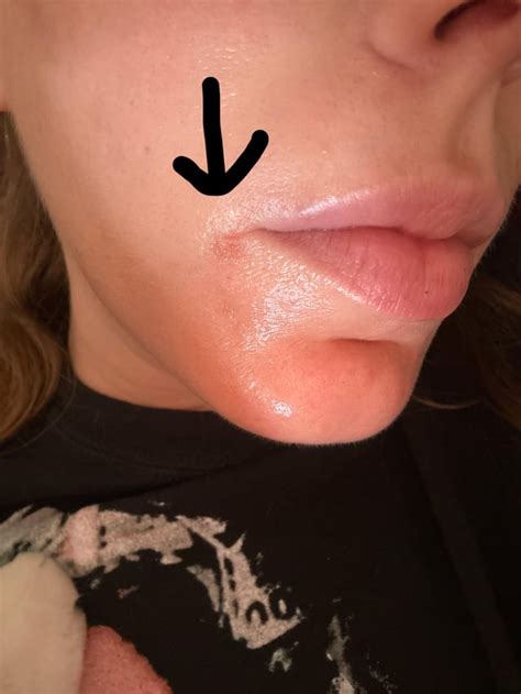 Red rash after healing cold sore : r/Coldsore
