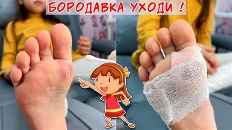 Удаление бородавок жидким азотом - показания, техника, последствия