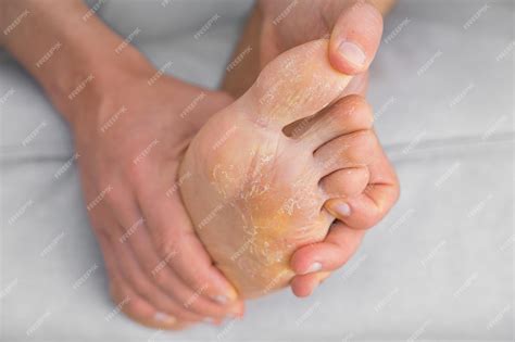 Descamação Do Pé - Homem com descamação e pés rachados Infecção fúngica ou pé de atleta ...