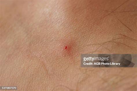 Black Fly Bites Photos and Premium High Res Pictures - Getty Images