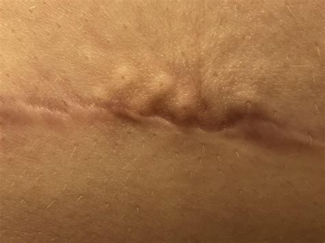 Does anyone know how it flatten this? Noticed it after my surgery. I’ve