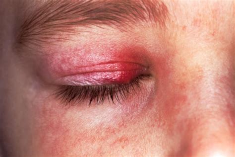 Eczema Rash On Eyelid