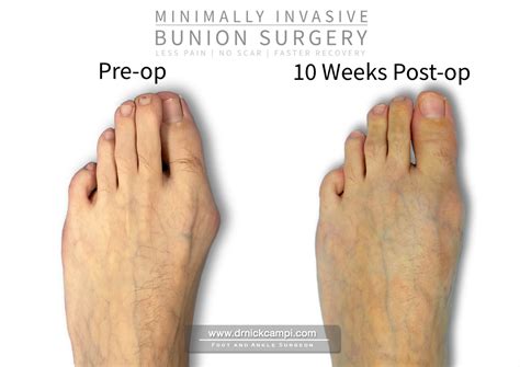Minimally Invasive Bunion Surgery in Akron, OH | Dr. Nicholas