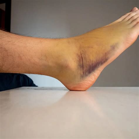 Sprained Ankle | Teton Foot & Ankle Center | Idaho Falls